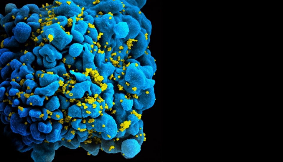 Das Bild zeigt eine HIV-infizierte T-Zelle.